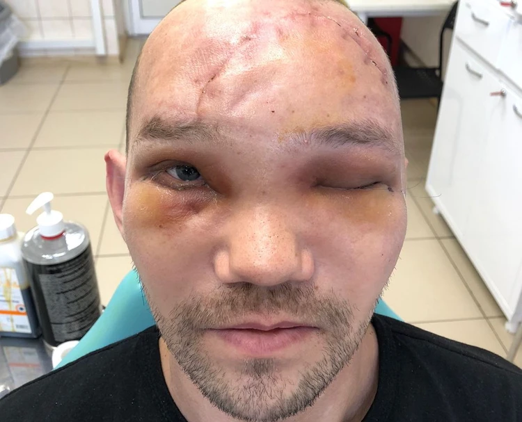 Сергей после операции.png