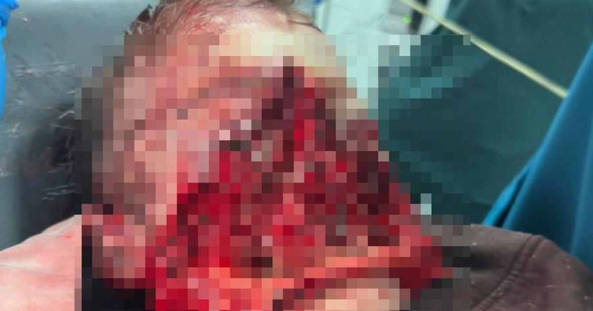 Отец мальчика, которому собаки разорвали лицо, рассказал подробности ЧП