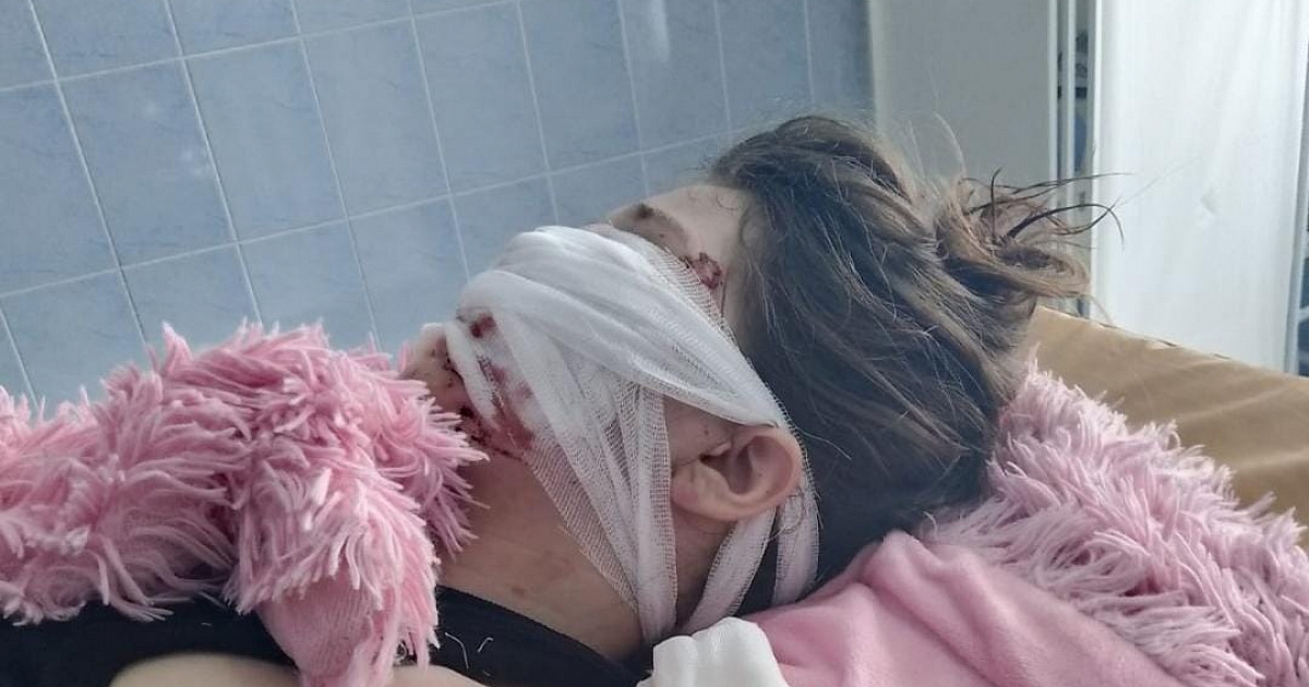 На Кубани родных девочки из Темрюка, лицо которой отгрызла собака, держат в неведении, они обвиняют врачей в «безумном самолюбии»