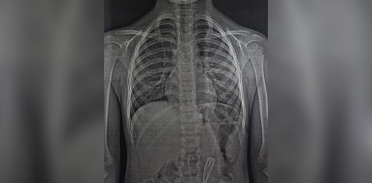 На Кубани 4-летняя девочка проглотила заколку-невидимку. Её спасли врачи